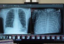 Штучні легені підтримують пацієнта протягом 48 годин, прокладаючи шлях до трансплантації